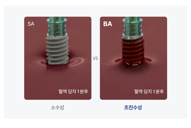 석플란트에서 오스템임플란트 궁금증 해결 관련 이미지 10