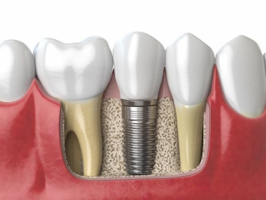 Comparing Meals and Foods After Implant Surgery image 4