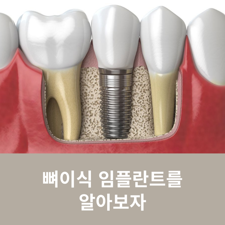 Let’s Learn About Bone Graft Implants image 11