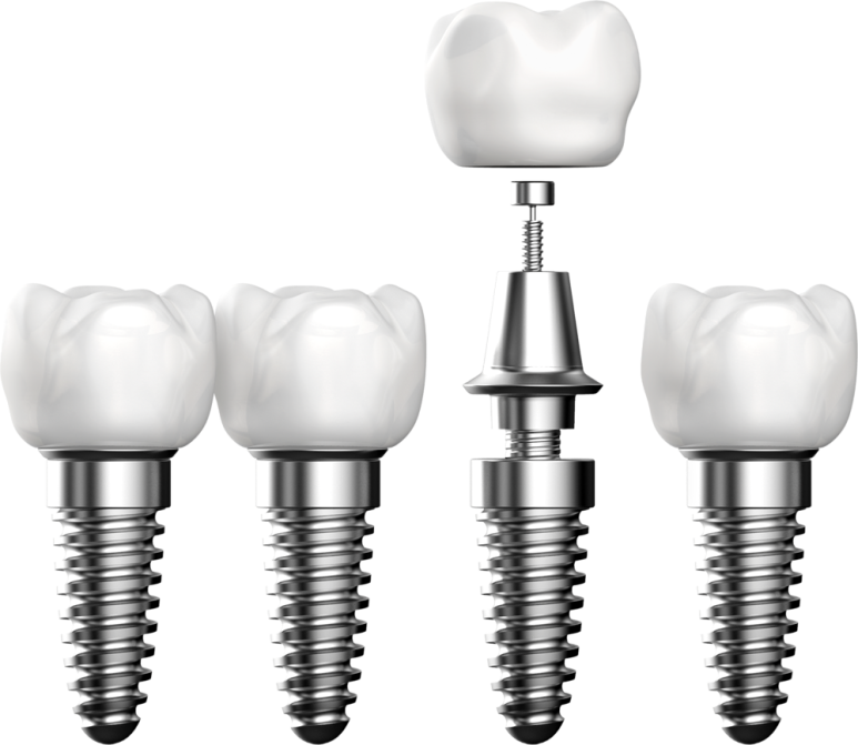 Things You Must Know Before Implant Surgery image 2