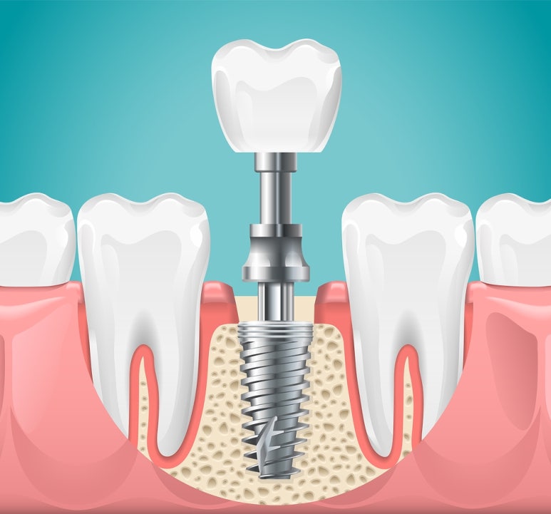 Lost My Tooth! Restore It with an Implant! image 5