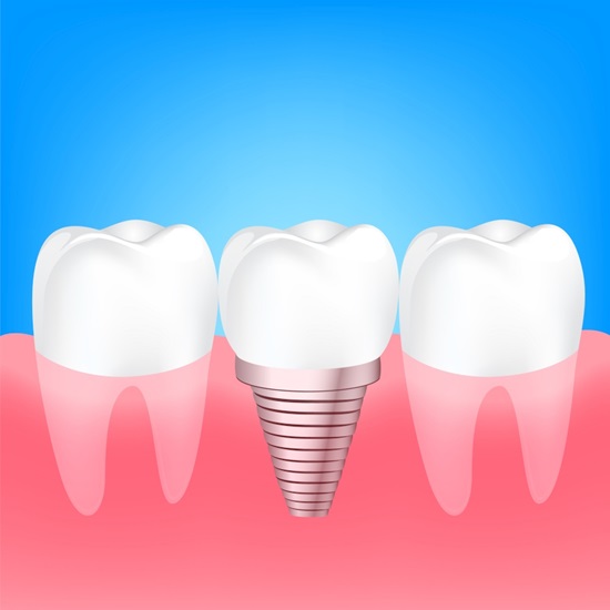 Want to Compare Implant Prices? Learn About Seok Plant Dental Hospital image 3