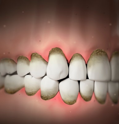 If You Want Implants to Last a Long Time, You Need to Change Your Habits image 3