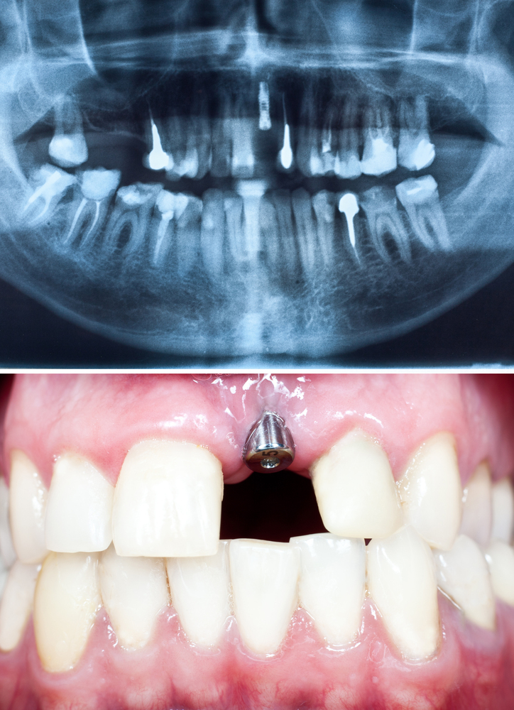 Countless Dental Concerns? Leave Them to Implants! image 7
