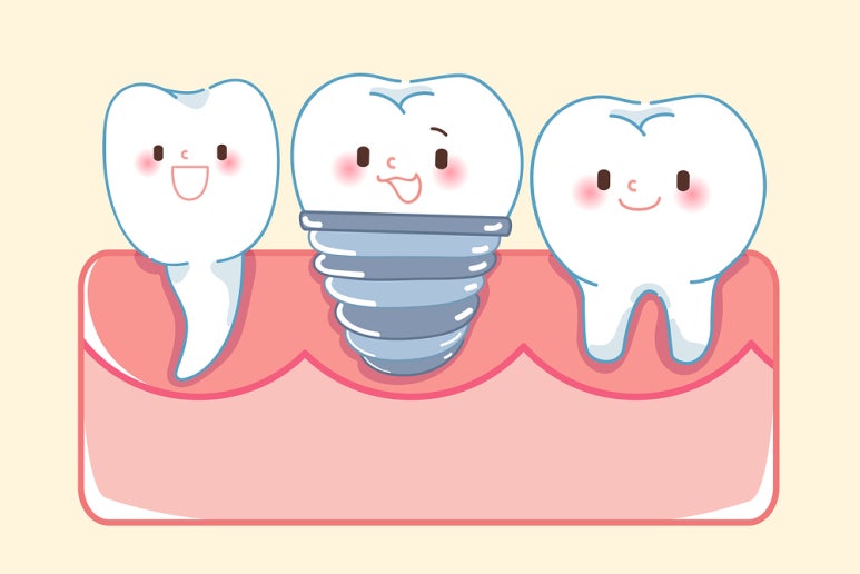 Let’s Regain Our Smile and Confidence with Implants! image 5