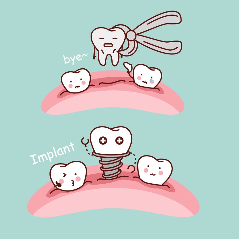 Could Ignoring Sensitive Teeth Lead to Implants? image 6