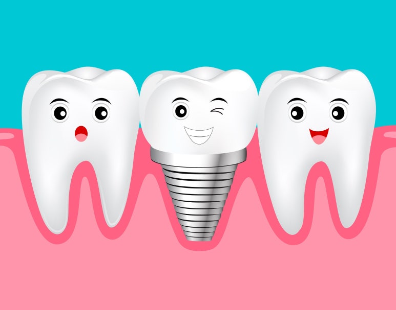 Learn About Implant Surgery at Seokplant Dental Hospital image 4