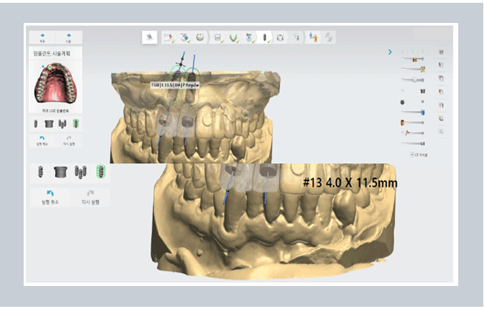 Implant Surgery: Don’t Put It Off! image 7