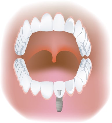Let’s Regain Our Smile and Confidence with Implants! image 6