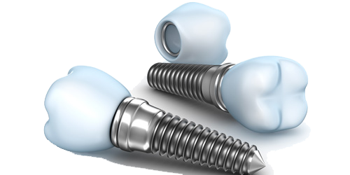 What Are the Types of Implants? Seokplant Dental Hospital image 3