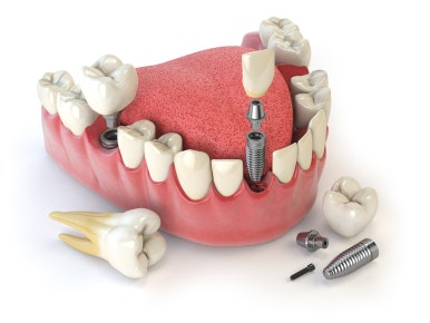 Implants: Treatment Timing and Aftercare Are Important! image 4
