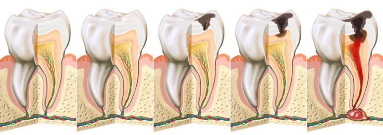 A Little Carelessness Can Lead to Tooth Loss! image 3