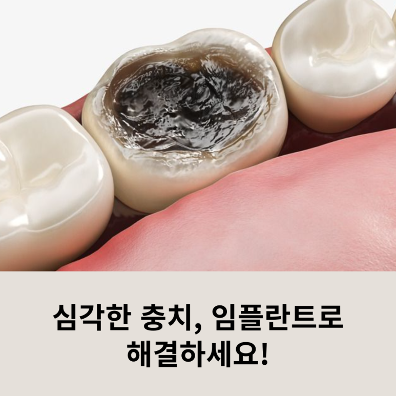 심각한 충치, 임플란트로 해결하세요! 관련 이미지 8