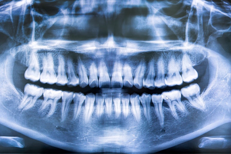 This Is What Happens If Tooth Loss Is Left Untreated image 4