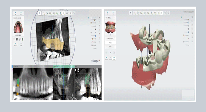 Precision Implants, Introduction to Navigation Implants image 1