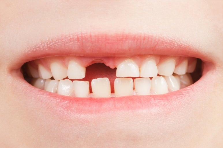 Spring Outdoor Activities! Be Careful of Tooth Damage! image 3