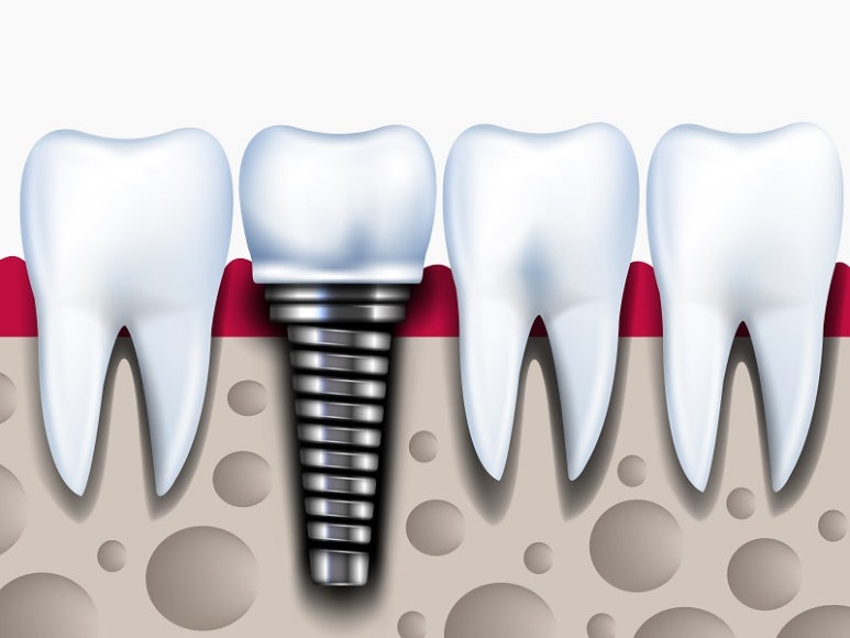 Bone Graft Implants: Information for Those Who Are Curious image 2