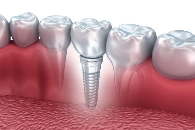 Why Is a Molar Implant Needed? Seokplant Dental Hospital image 2