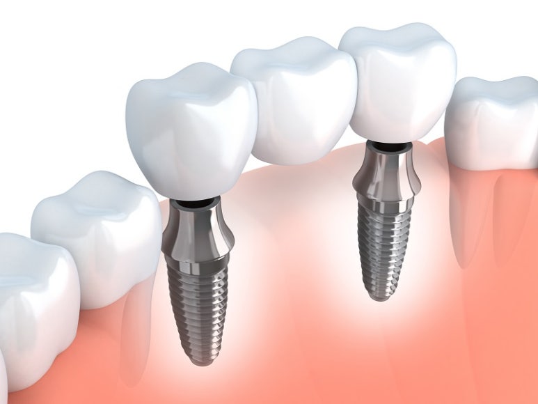 Want to Compare Implant Prices? Learn About Seok Plant Dental Hospital image 4