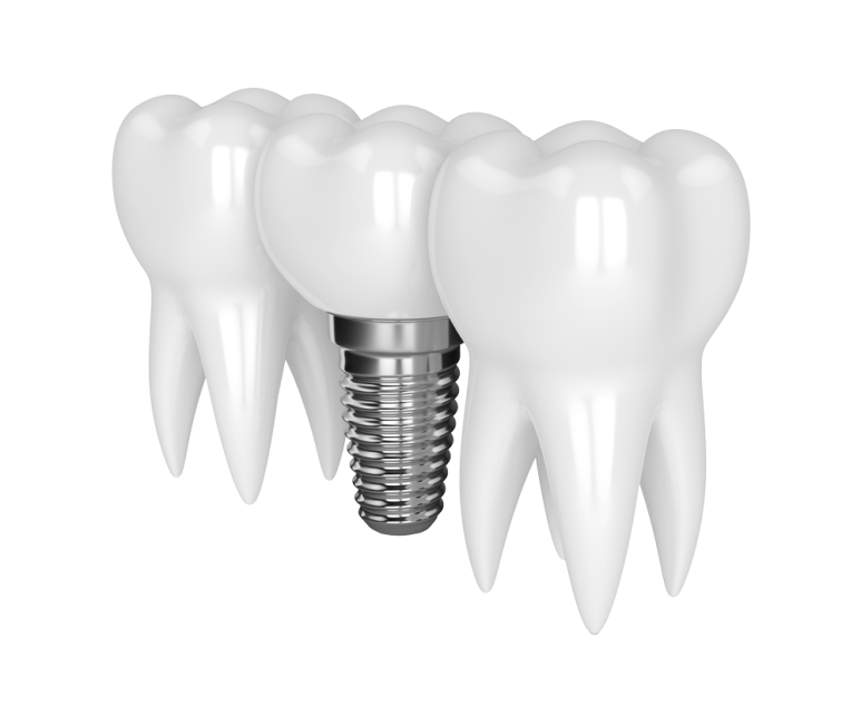 Strong as Natural Teeth! From the Implant Placement Process to Health Insurance, All at Once! image 1