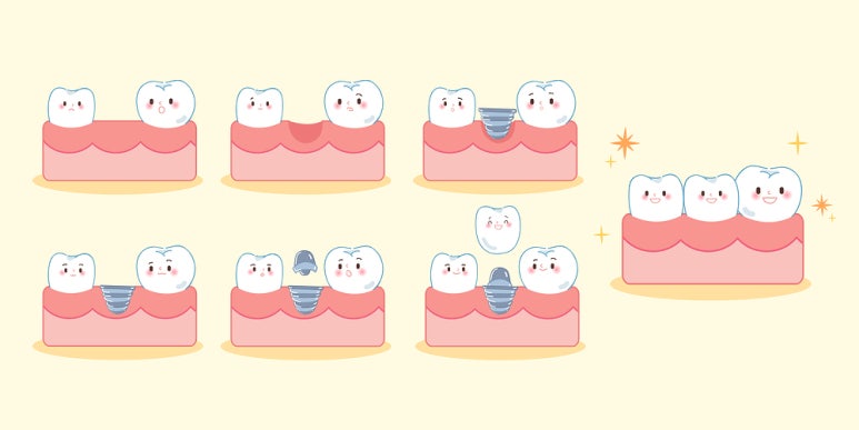 Implant Surgery: Don’t Put It Off! image 3
