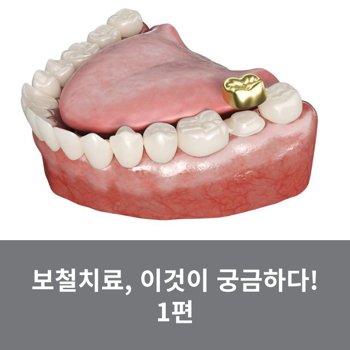 Prosthodontic Treatment: What You’re Curious About! Part 1 image 7