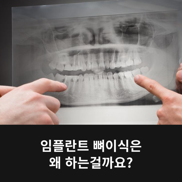 임플란트 뼈이식은 왜 하는걸까요? 관련 이미지 8