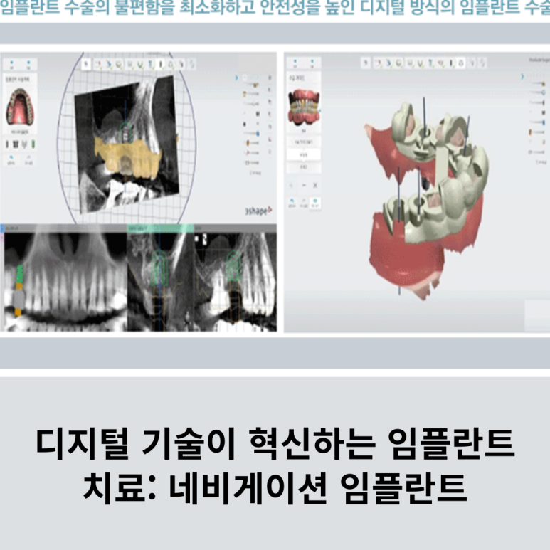 Implant Treatment Transformed by Digital Technology: Navigation Implants image 7