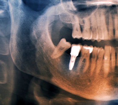 Implants: Treatment Timing and Aftercare Are Important! image 7