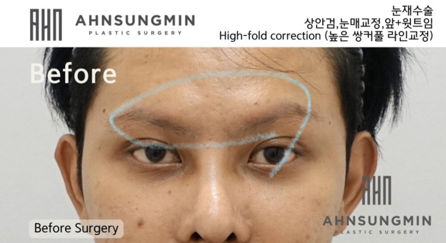 재수술 남자 하이폴드 교정수술 [높은 라인 교정 재수술] High-fold correction 안성민원장 관련 이미지 4