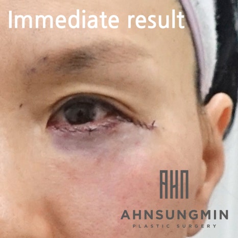 중년의 눈밑지방재배치 수술과 회복 과정 알아보기 관련 이미지 3