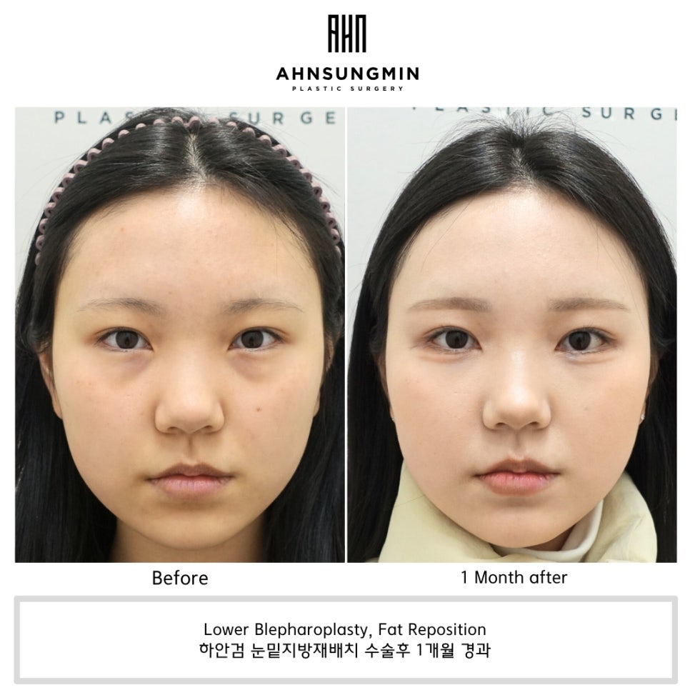 나이대별 눈밑지방재배치 수술 전후 사진 비교 관련 이미지 1
