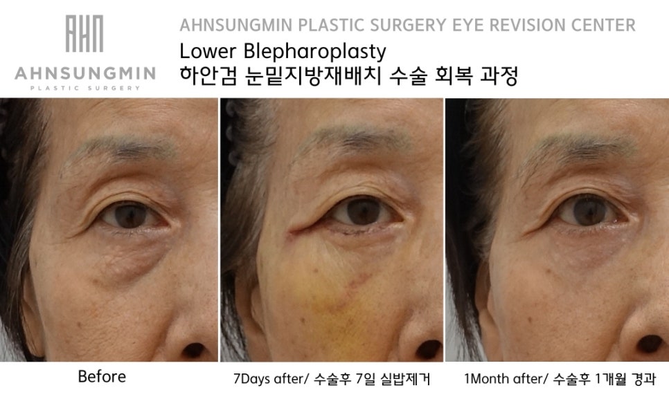하안검 수술시 중안면 근육 거상의 중요성 [성형외과 전문의 안성민] 관련 이미지 4