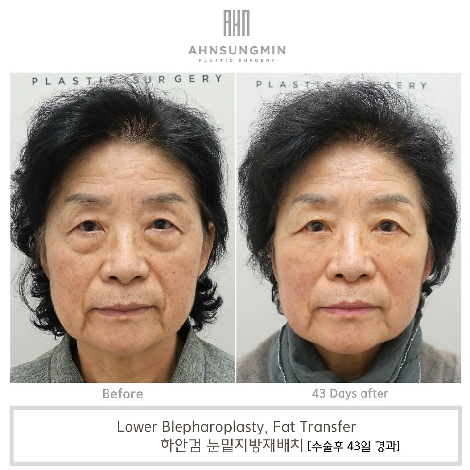 하안검 수술 시 중안면 근육 거상의 중요성 [성형외과 전문의 안성민] 관련 이미지 2