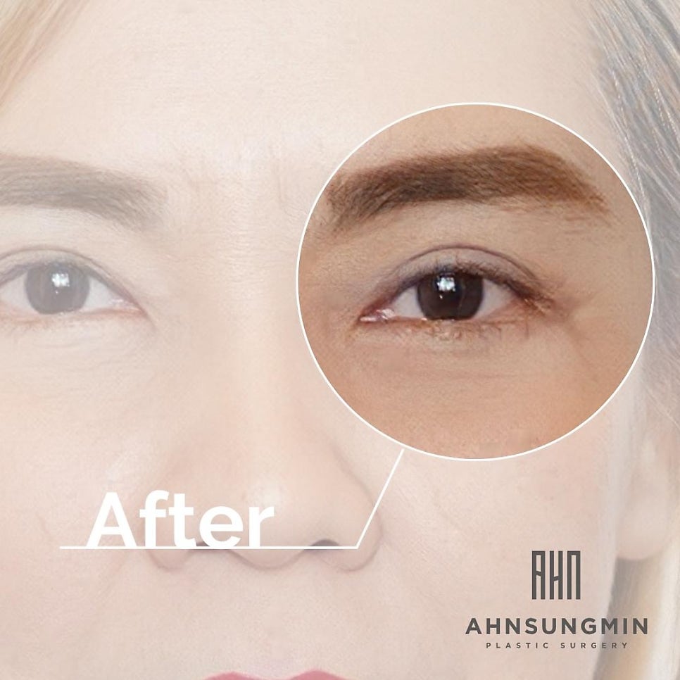 눈재수술전문 재수술이 어려운 이유 관련 이미지 4