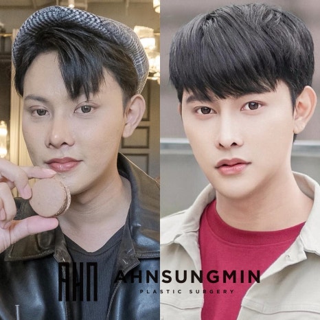 느끼한 남자 눈 무쌍이 되고 싶어요. 두꺼운 쌍꺼풀 낮추기 관련 이미지 6