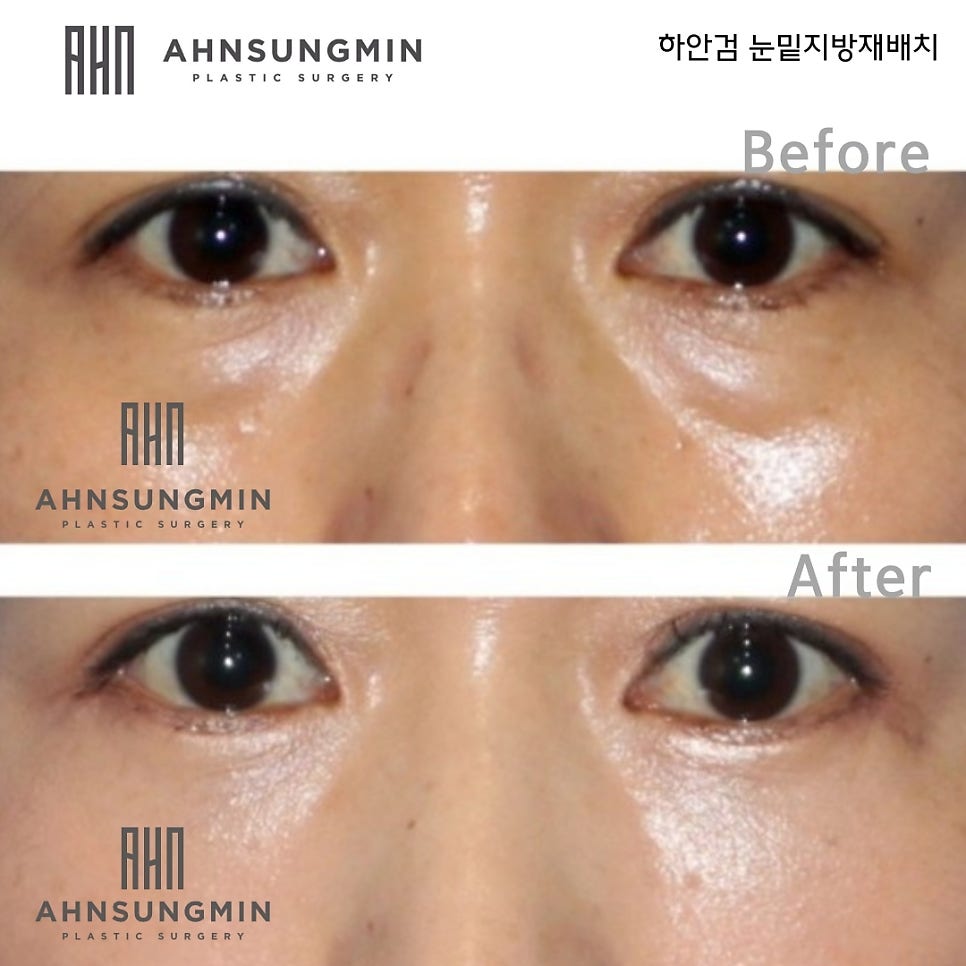 하안검 수술에서 애교살을 보존해야 하는 이유 관련 이미지 2
