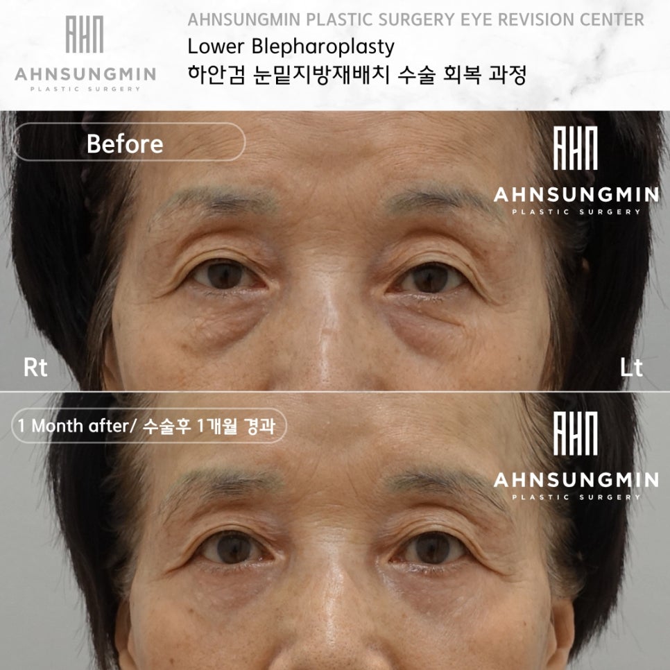하안검 수술시 중안면 근육 거상의 중요성 [성형외과 전문의 안성민] 관련 이미지 3