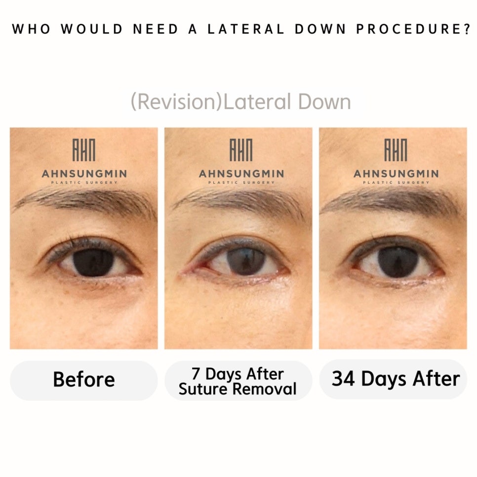 트임성형(뒤트임과 뒤내림,눈밑트임) 성형외과 전문의 안성민성형외과 관련 이미지 2