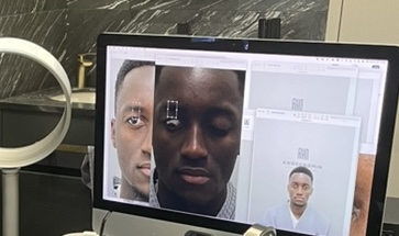 선천성 안검하수 짝짝이 눈매교정 재건수술[성형외과 전문의 안성민] 관련 이미지 3