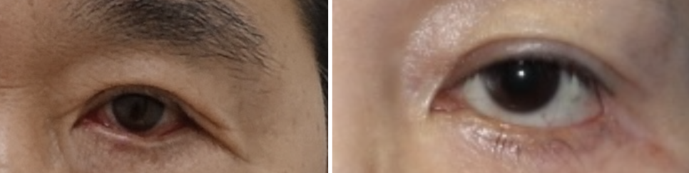 하안검 수술 시 중안면 근육을 당기는 이유 관련 이미지 1