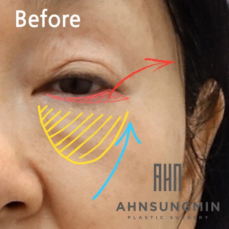 중년 눈 밑 지방재배치 애굣살(애교살) 보존 이유 관련 이미지 4