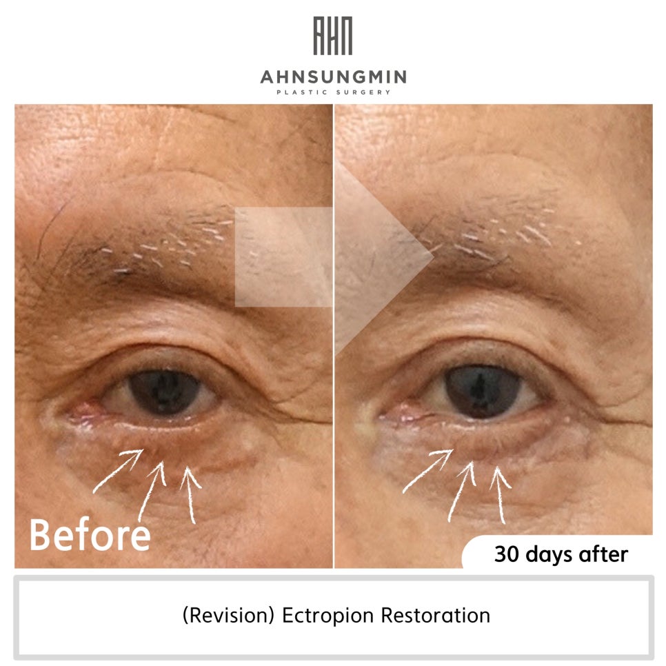 안검외반 교정 복원 전후 관련 이미지 4