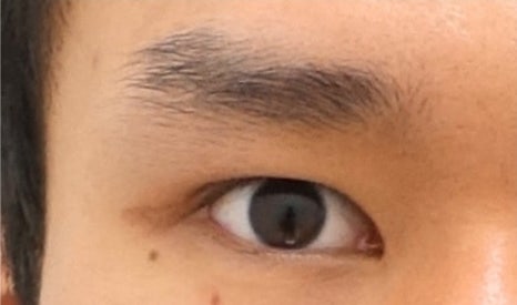 남자 눈성형 두꺼운 쌍꺼풀 풀기 관련 이미지 4