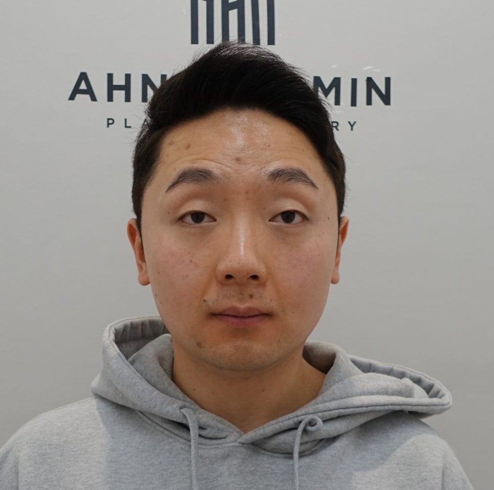 20대 남성 안검하수 증세와 눈매교정 수술 후 3개월 경과 관련 이미지 3