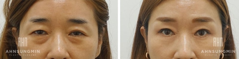 짝눈교정 절개 비절개 어떤 방법이 좋을까? 관련 이미지 6