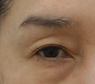 뒷트임과 하안검 수술의 공통 수술 범위. 성형외과 전문의 안성민 관련 이미지 4