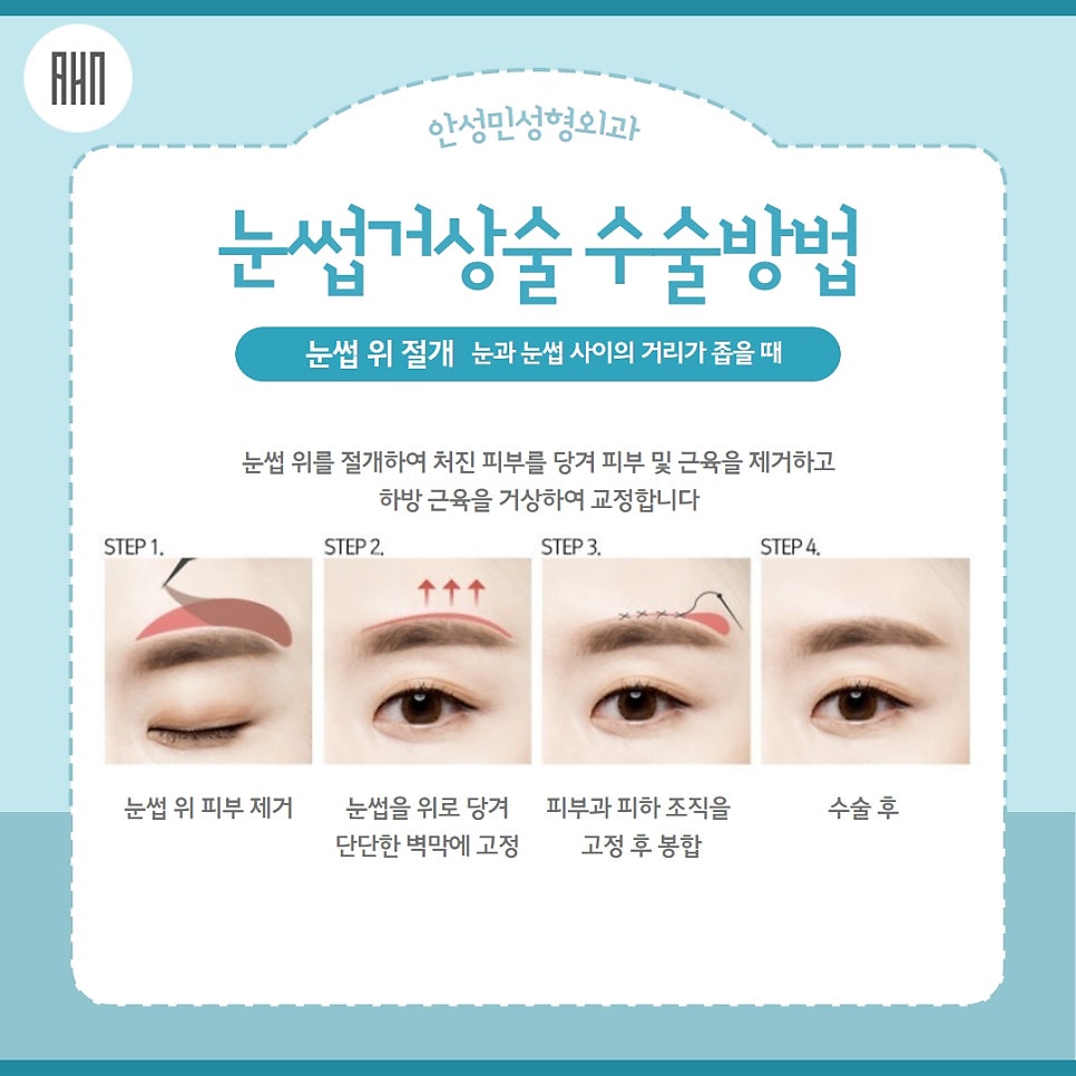 눈썹상거상 꼭 필요할까? 관련 이미지 5