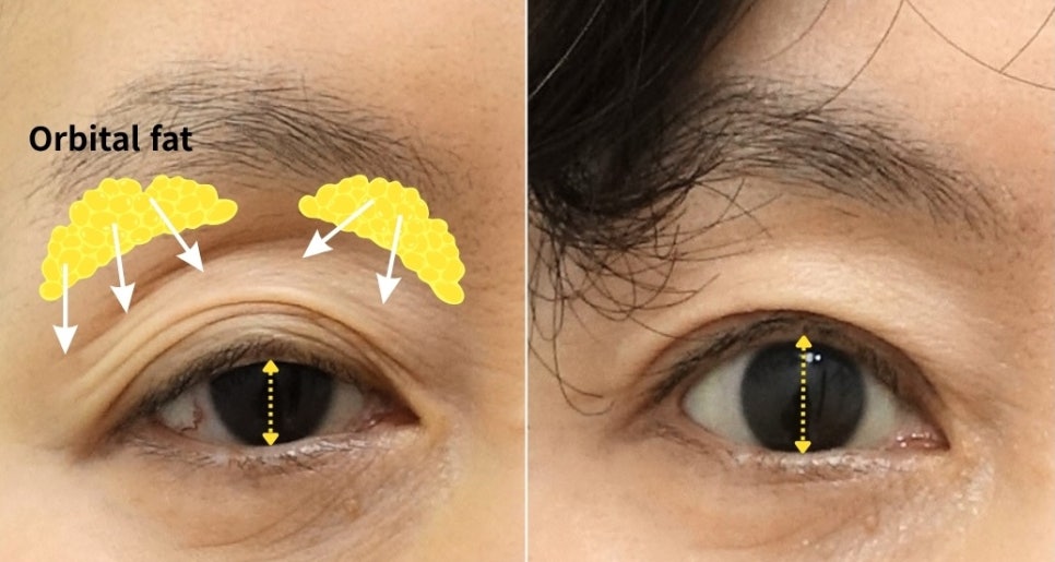 Upper Eyelid Hollowness That Develops With Age Is Not Simply Caused by Fat Loss image 1