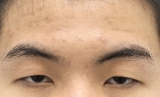 20대 남자 안검하수, 졸린 눈 어떻게 해결할까? 관련 이미지 1